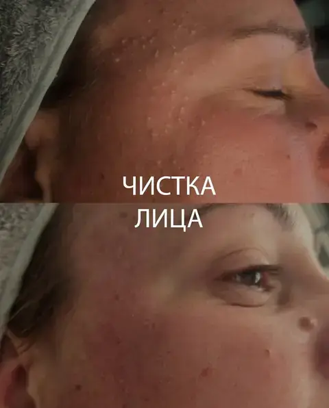 Чистка лица — результат